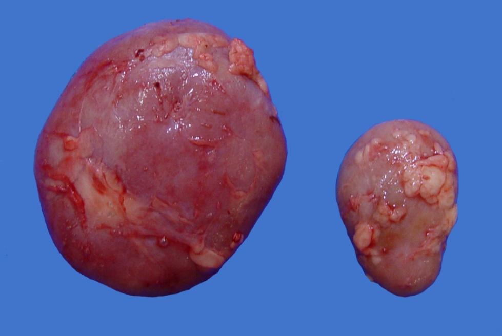 Description: The lymph node on the left is diffusely enlarged