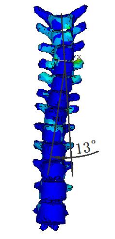 2º smaller than that of uncorrected spine, as shown in Figure 15.