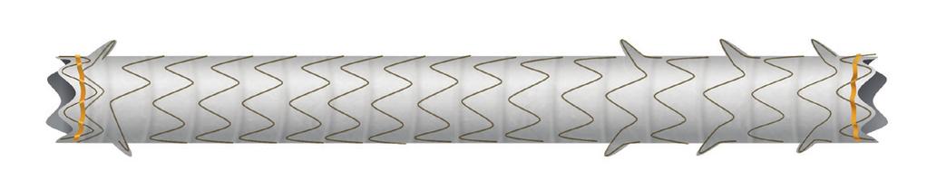 Competitive differentiation LOWEST MIGRATION RATES GORE VIABIL Short Wire Biliary Endoprosthesis is the only fully covered metal stent designed to minimize migration and has supporting clinical data.