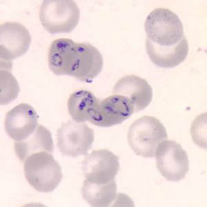 Babesiosis Agent: Babesia microti (most commonly cause of disease in humans) Infects red blood cells Clinical Signs May be asymptomatic Signs develop within a week of bite, progress over weeks to