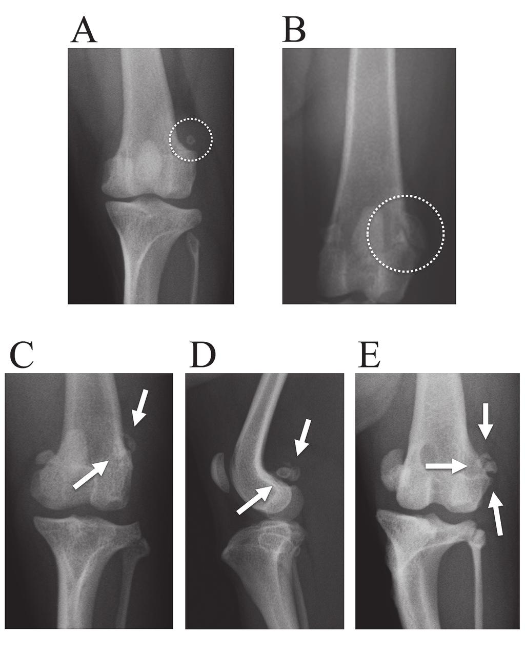 Shinji Yasukawa et al. 47 Fig. 5. Deformity of the lateral fabella. (A) Hypoplasia (craniocaudal view of the left stifle). (B) Hyperplasia(craniocaudal view of the left stifle).