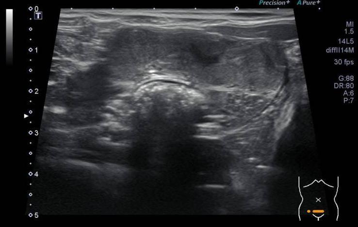 Ultrasound interpretations: There is a trace amount of anechoic peritoneal effusion between liver lobes. The spleen is mildly enlarged with normal echogenicity and sharp margins.