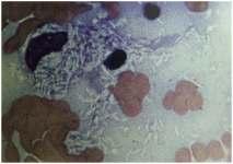 Mycobacterium spp (Zeilh-Neelson Stain) Radiology: On X-rays virtual complete obliteration of the
