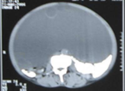 The other rare sites reported to be involved by hydatid cyst are peritoneal cavity, spleen (5.