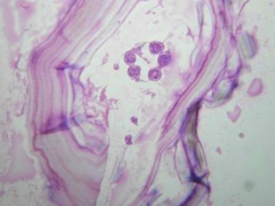 (40X) Figure 7 Figure 7: Photomicrograph revealing fibrous and chitinous wall and attached daughter cyst with invaginated morphology having scolex and germinal lining.