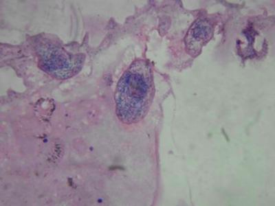Figure 16 Figure 16: Photomicrograph showing inner chitinous wall with attached daughter cysts having invaginated morphology alongwith scolex and germinal lining.