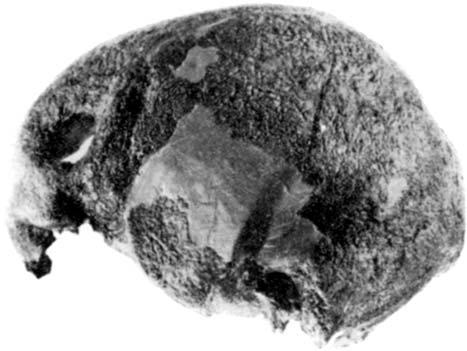 Three Trephined Early Bronze Age Skulls from Bohemia A B C FIGURE 1. Trephined skull from Hřiby by Kolín (Únětice Culture, Early Bronze Age).