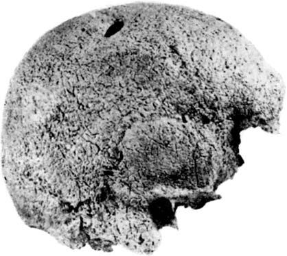Three Trephined Early Bronze Age Skulls from Bohemia A B C FIGURE 5. Trephined skull from Polepy by Kolín in Bohemia (Únětice Culture, Early Bronze Age).
