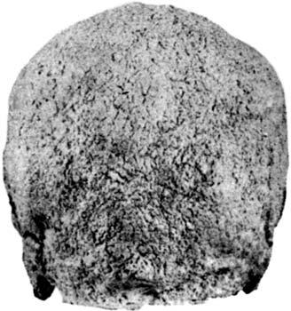 The skull base is damaged in the neighbourhood of the large occipital opening; it is difficult to say whether secondary damage caused during archaeological excavation, or an