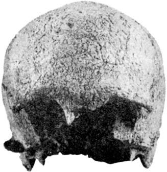 In the lateral view (Figure 5:A) we can notice on the frontal bone strong supraorbital arches. The frontal squama is medium high and mediocre arched.