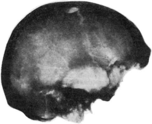Three Trephined Early Bronze Age Skulls from Bohemia FIGURE 7. Trephined skull from Polepy by Kolín in Bohemia (Early Bronze Age, Únětice Culture). X-ray picture in norma lateralis.