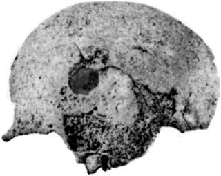 In norma verticalis (Figure 9:B) we can also see according to incomplete remnants that the skull was of ellipsoid shape, markedly dolichomorphous, most likely hyperdolichocranial.