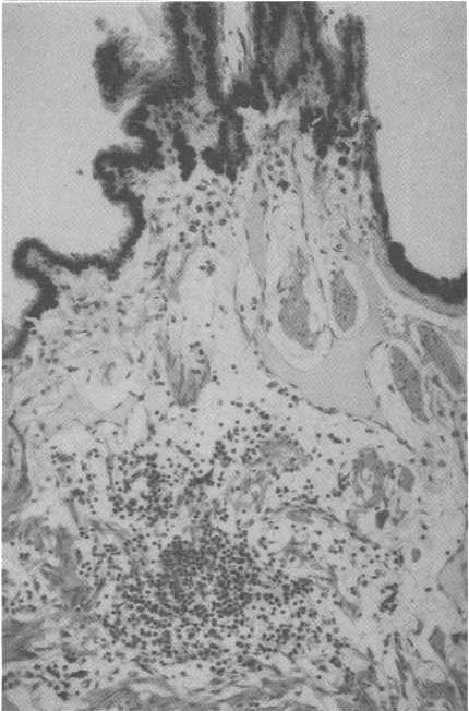 The Effect of FIV Infection on the Eye in Cats 307 Fig. 1. Diffuse infiltration of mononuclear cells in a ciliary body. Magnification: x 175 Table 1.