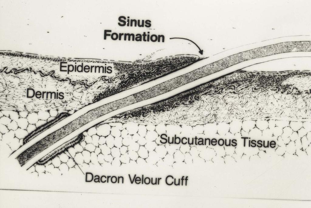 Sinus formation Dermis Epidermis