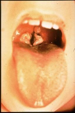 This child has diphtheria resulting in a thick gray coating over back of throat.