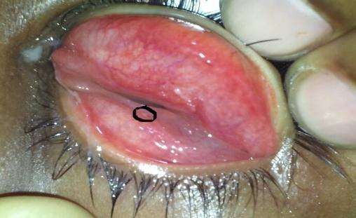patient from a rural area presents with signs and symptoms of acute conjunctivitis with typical history of being struck by a fly.