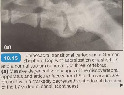 Transitional vertebrae Lumbosacral transitional vertebrae are the malformation of the bone through the pelvis that shows anatomy of both the lumbar vertebrae and the sacral vertebrae Due to the