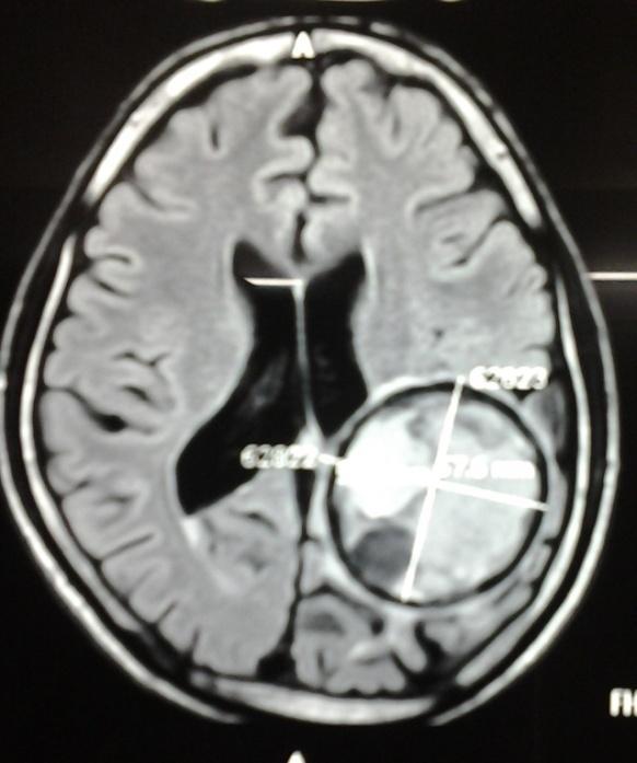 CASE REPORT A 12 year old boy, shepherd by occupation presented to Department of Neurosurgery with three months history of headache, vomiting and giddiness.