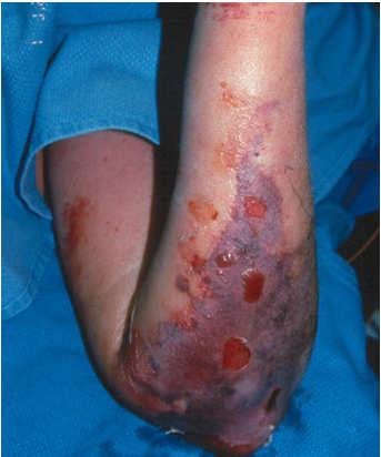 Case 4 34 y/o M comes in with arm pain, fever Temp 38.9, HR 105, SBP 100, RR 20 Appears ill and in more pain than what you would expect for cellulitis What would your empiric therapy be in this case?
