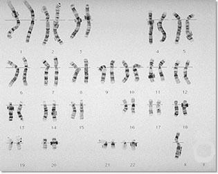 Use this karyotype above to answer question 20 20. What is wrong with the above individual? a. The above individual is normal. b. The above individual has an extra chromosome c.