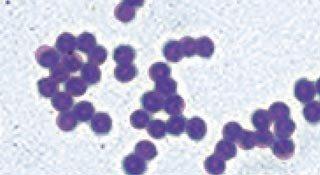 when focusing the microscope. Figure 8 shows degenerate neutrophils with intra and extra-cellular cocci diagnostic for bacterial otitis, most likely associated with S pseudintermedius.