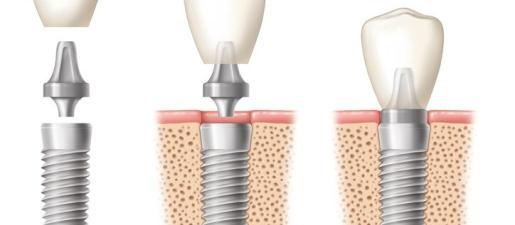 in dental implants Prophylaxis