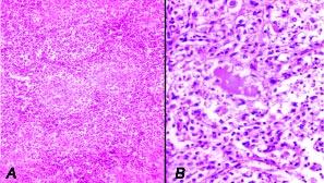 Lymphoid tissue depletion and RE cell hyperplasia in medulla of bursal