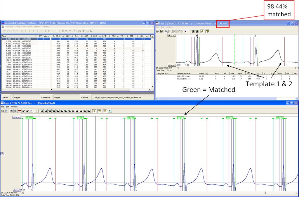 ECG ANALYSIS Ponemah ECG Pro module for template analysis Raw data (1