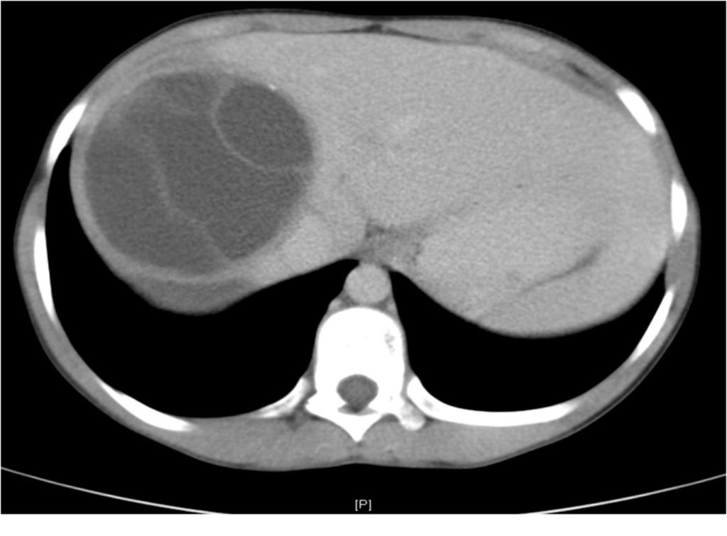 Fig. 6: CT image of the same patient as in Figure 8 fails to demonstrate the