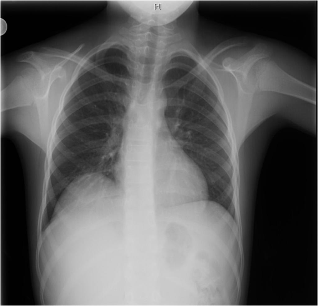 Fig. 7: PA chest X-ray of a pediatric patient with liver