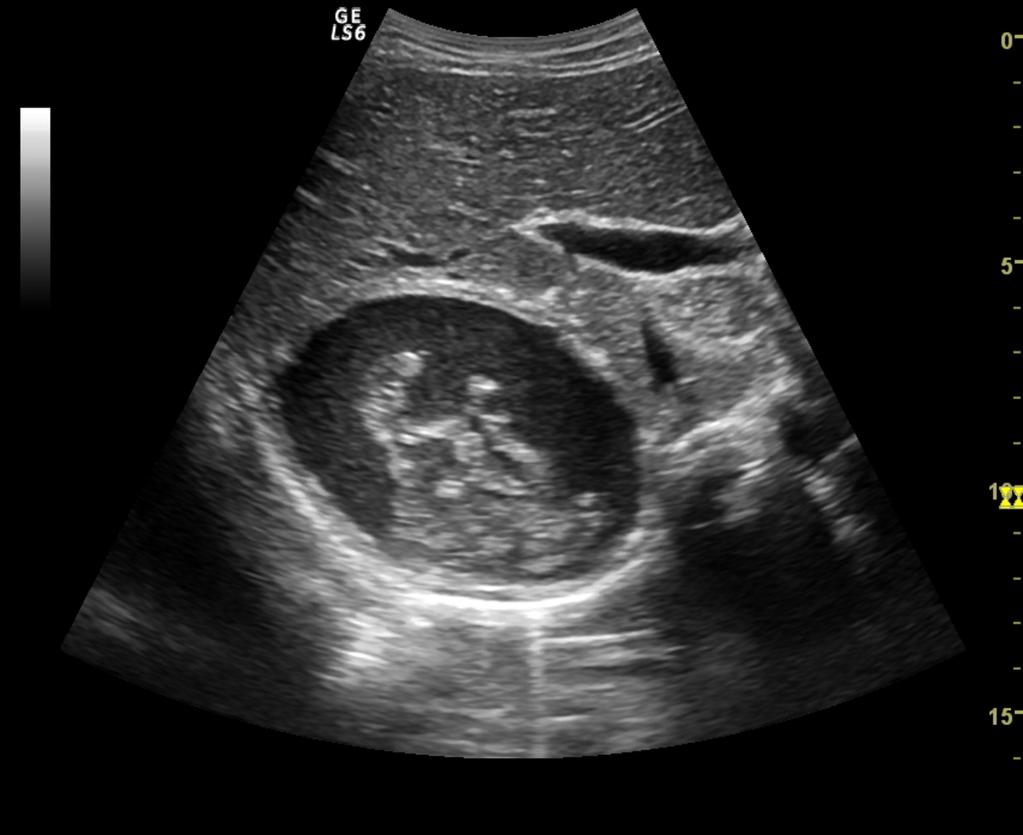 Fig. 8: US image of the same patient in Figure 4 demonstrates complex solid-cystic multivesicular hydatid cyst ( WHO type CE