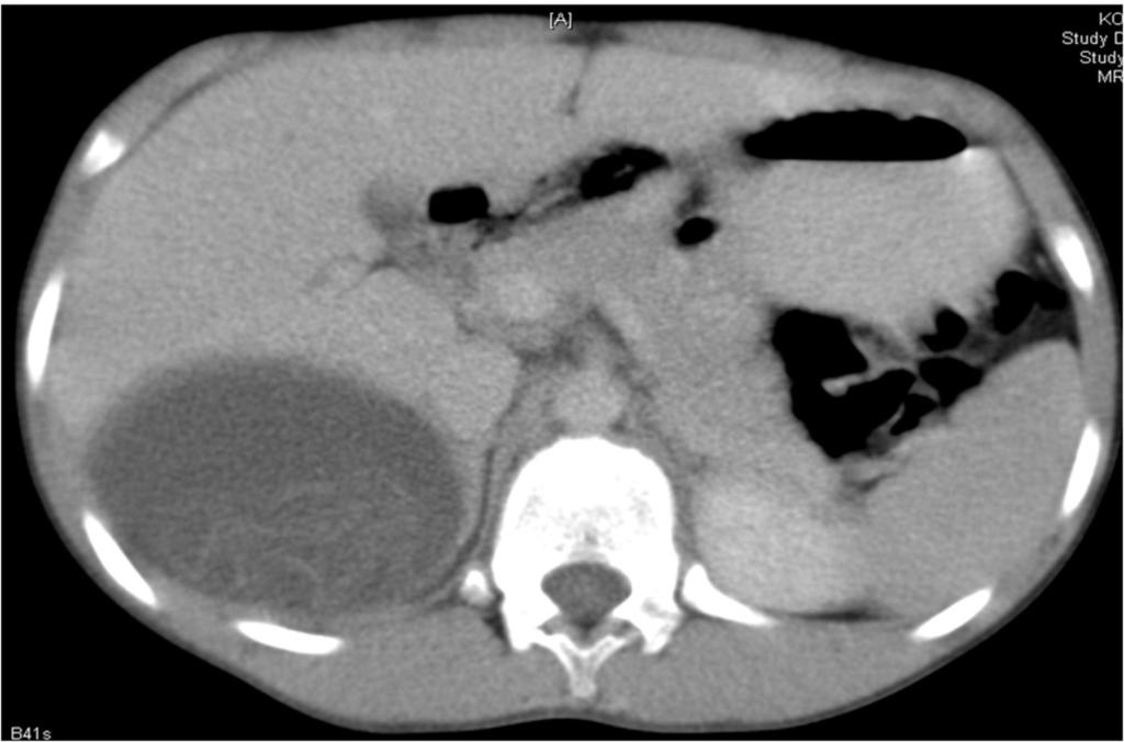 Fig. 9: CT image of the same patient in Figure 3 and 4. A large subdiaphragmatically located distended cyst with internal septations is seen in segments 7/8.