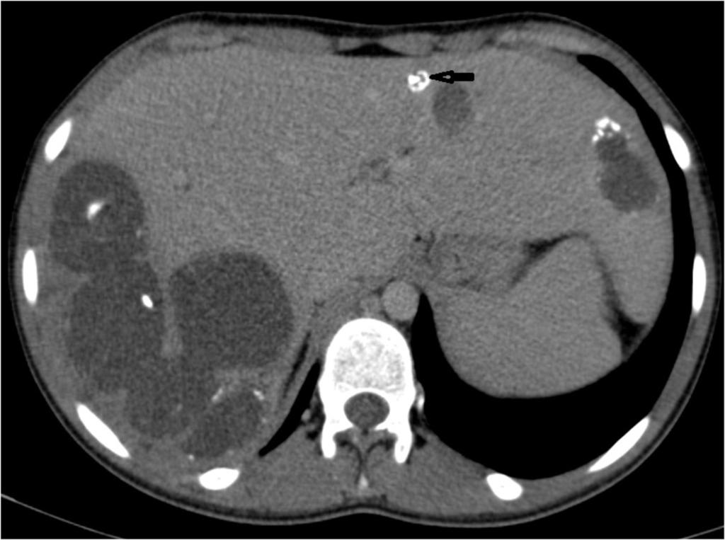 Fig. 10: CT image of a patient with multiple hydatid cysts some with wall calcifications.