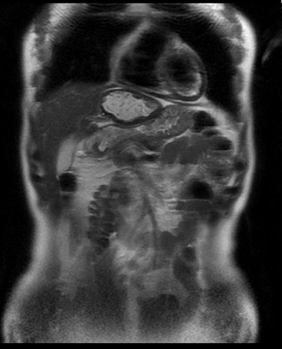 Fig. 11: Coronal T1 weighted MR image of a patient with hydatid cyst