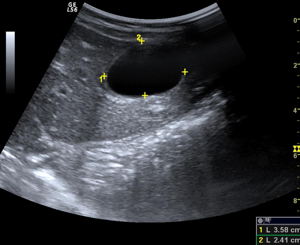 Fig. 2: US image shows a large active unilocular simple cyst with uniform anechoic content and