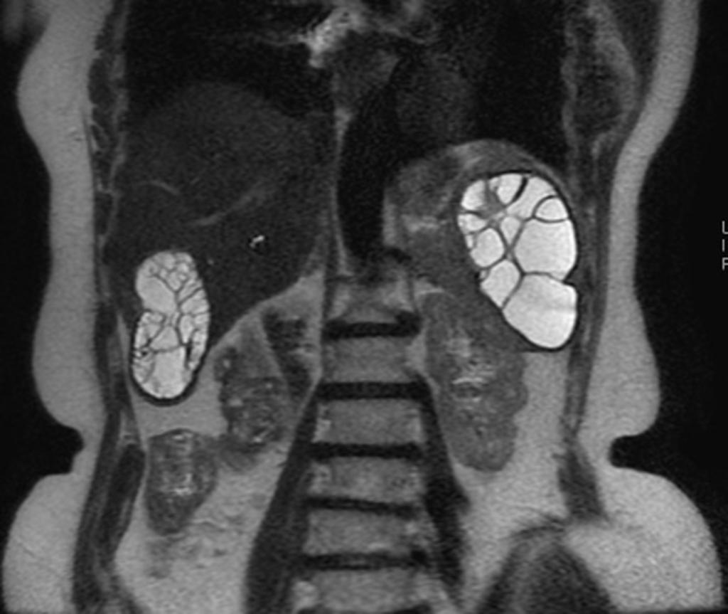 Fig. 4: T2 weighted MR image shows large WHO type CE 2 subcapsular cysts both in liver and spleen which pose a risk