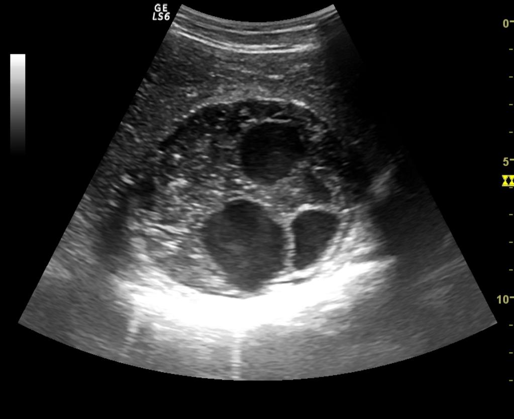 Fig. 5: US image of a patient with liver hydatidosis shows detached