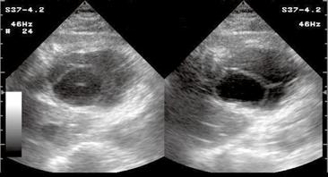 US images of the liver show septations producing linear echogenic bands within the hydatid cyst.