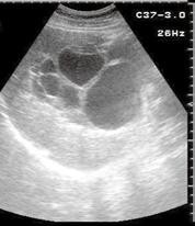 Fig. 10 Partial detachment of cyst walls. US image of the liver shows echogenic material with some hypoechoic curvilinear areas in the hepatic cyst.