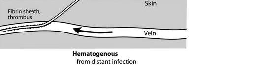 Case definitions of Healthcare-Associated Infections: definitions SSI Surgical site infection Superficial incisional Organ/Space Deep incisional (SSI-D) Infection occurs within 30 days after the