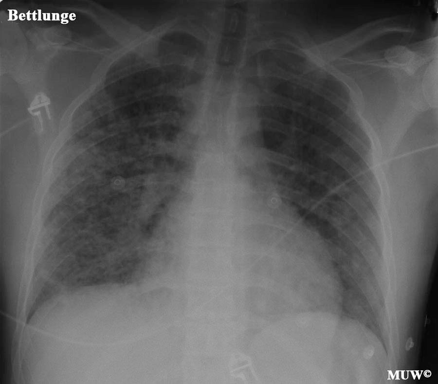 X-ray C/P- Radiography: interstitial infiltrations on