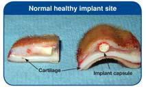 2/24/2018 Implant Site Quality Localized Antibacterial Protection Component with Tylan implants include a Tylan pellet (tylosin tartrate) as the first pellet in each dose The blue