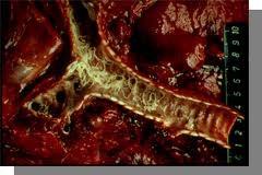 Lung Worm in Cattle The disease is caused by the worm Dictyocaulus viviparus. Adult worms live in the animal s lungs where they produce eggs which hatch quickly.