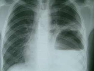 Chest X-ray showing a large cavity with a germinative layer in the left lung However, CT scan can display the cystic appearance of a pulmonary mass lesion and help localize