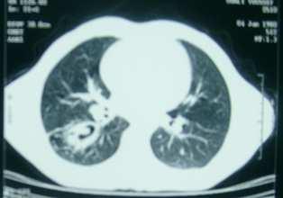 9%-25% [13, 14]. We also noted that huge pulmonary cysts occur more often in children than in adults.