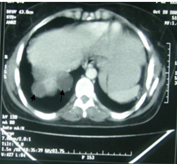 Thoracic Hydatid Cyst: Clinical Presentation, Radiological Features and Surgical Treatment http://dx.doi.org/10.5772/53533 207 Figure 17.