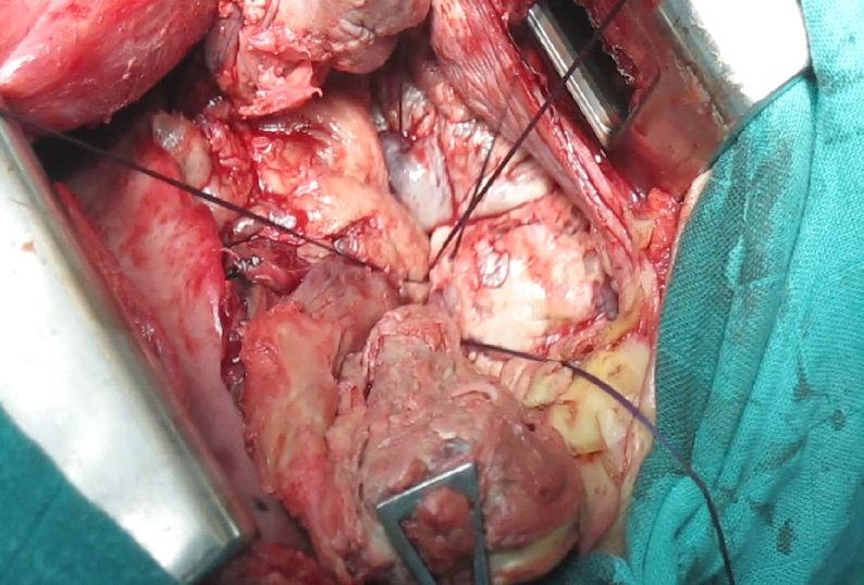 Thoracic Hydatid Cyst: Clinical Presentation, Radiological Features and Surgical Treatment http://dx.doi.org/10.