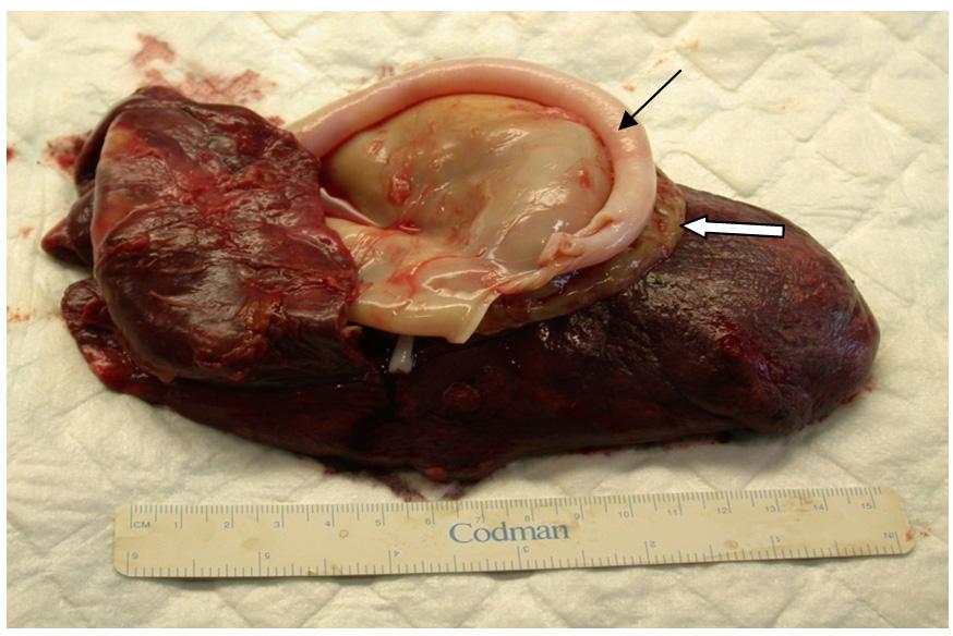 Thoracic Hydatid Cyst: Clinical Presentation, Radiological Features and Surgical Treatment http://dx.doi.org/10.5772/53533 197 Figure 2.