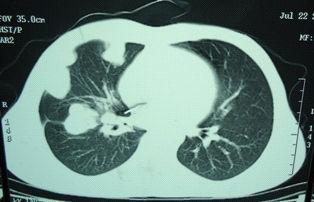 Thoracic Hydatid Cyst: Clinical Presentation, Radiological Features and Surgical Treatment http://dx.doi.org/10.