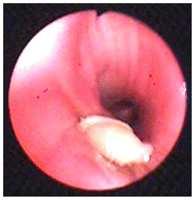 Bronchoscopy is unnecessary in patients with a typical clinical and radiological picture but it can be performed for differential diagnosis in cases of atypical radiological appearance [5, 6].